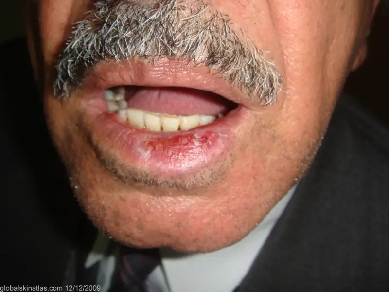 Lichenoid Dermatitis on the lip of an adult male. The inflammation is bright red and takes up one half of the bottom lip. Some swelling is also seen.