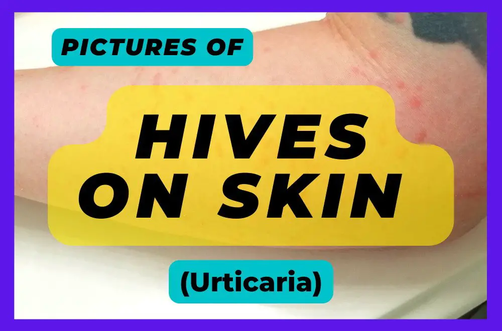 26 Pictures of Hives (Urticaria) on Skin