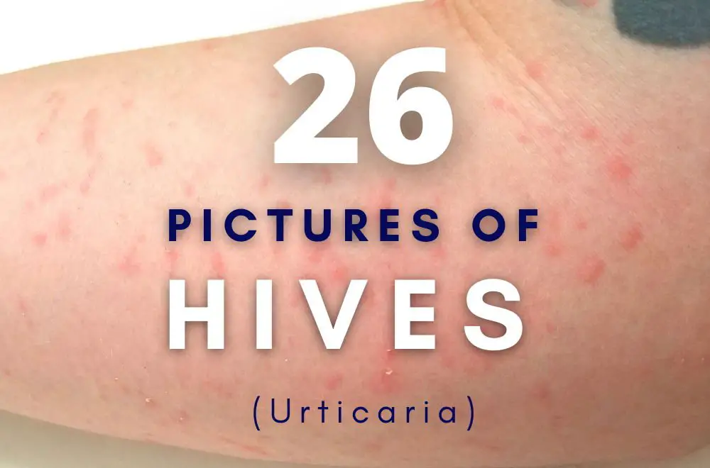 26 Pictures of Hives (Urticaria) on Skin