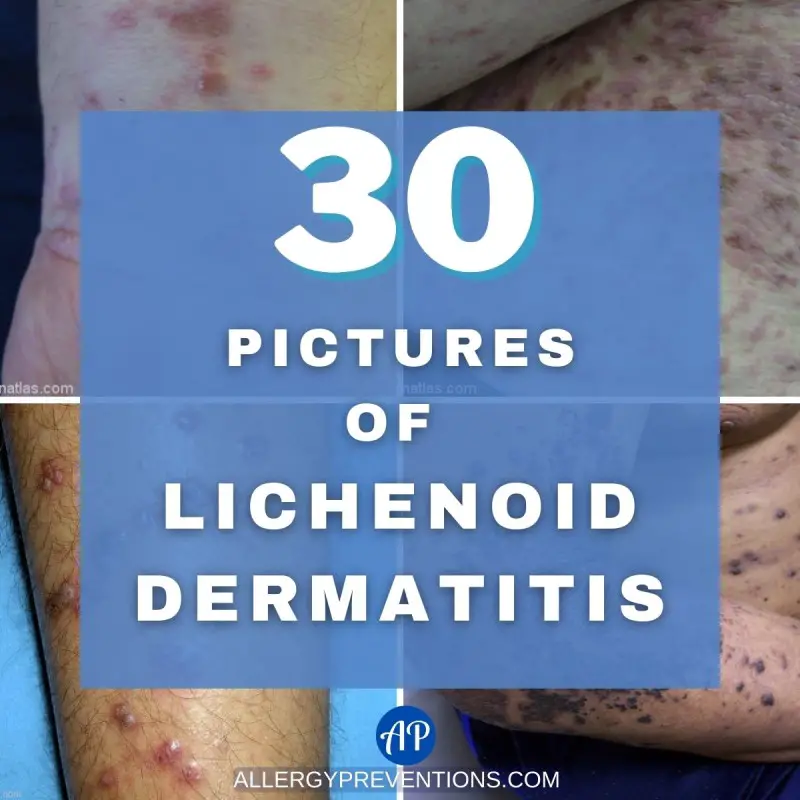 30 Pictures of Lichenoid Dermatitis