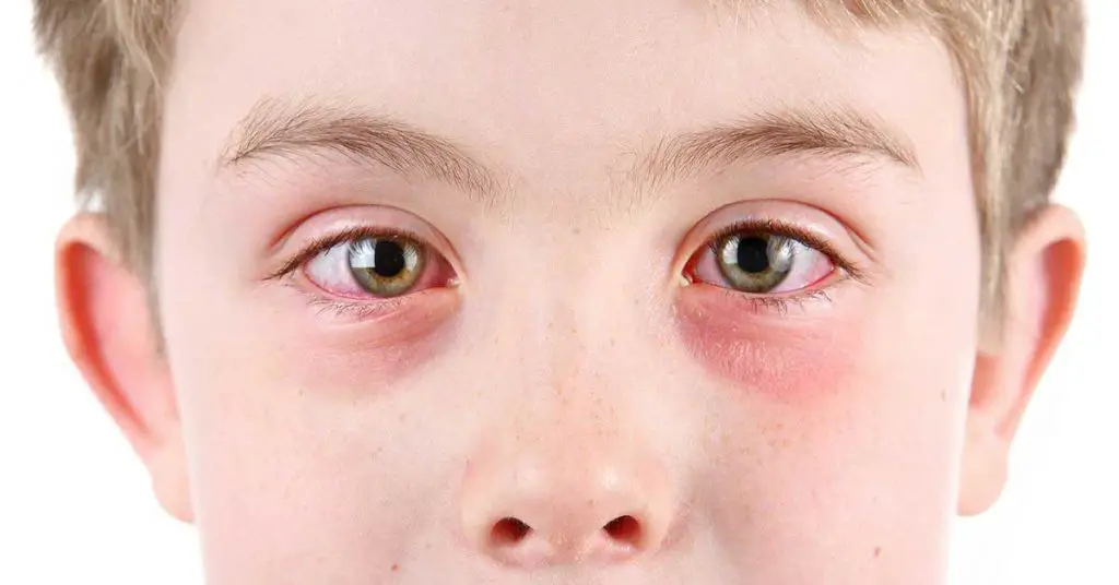 Boy with pink eye in both eyes. Eyes are red and watery. 