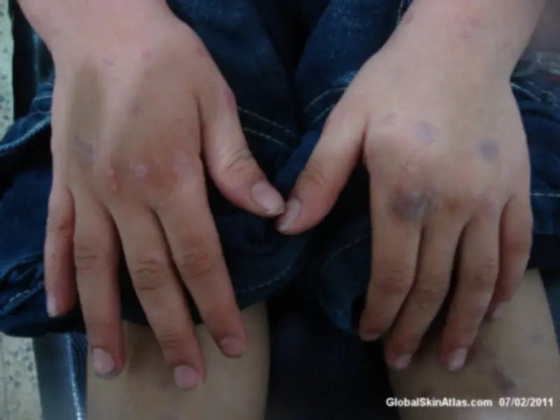 Lichenoid Dermatitis on the top of both hands. The eczema color varies from whitish, to dark purple. The fingers, knuckles, and tops of the hands are affected.