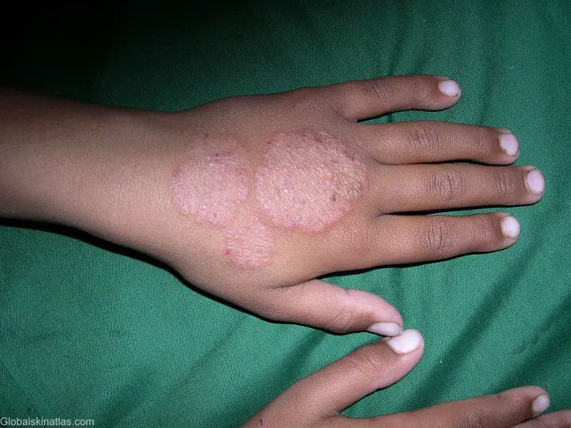 ringworm on left hand of a child caused by tinea dermatophytosis. Three different sized ringworm lesions are seen on the top of the hand. Some of the skin has broken and shows minor blistering.
