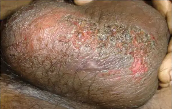 scrotal eczema on a dark skinned male. The scrotum seems very inflamed with crusty skin, scabs, redness, and what look to be sores. 