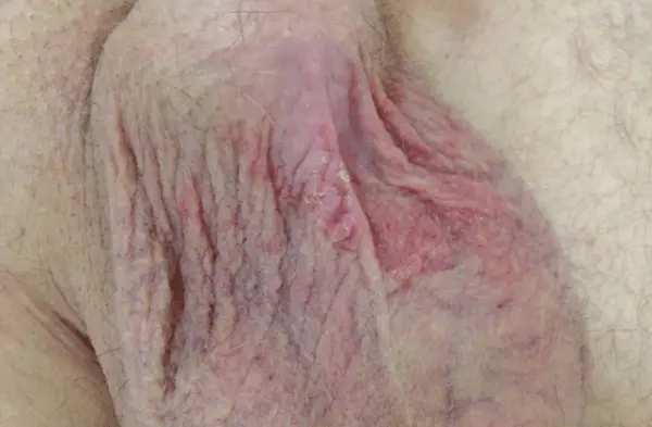 Male scrotum (balls) with red inflammation on the left and right side, near the base of the penis. Some scabs noted in the center of the scrotum. 