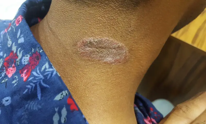 solitary lichenfield dermatitis on the neck of a young male. The patch of eczema is oval-shaped, and is a lighter color compared to the surrounding healthy skin.