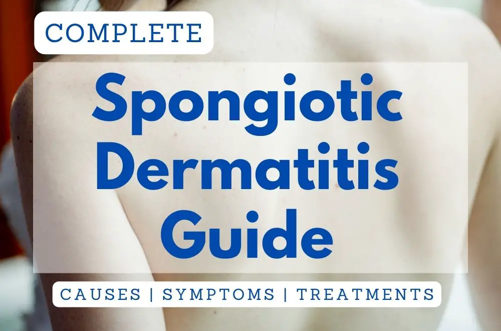 complete spongiotic dermatitis guide: causes, symptoms, treatments, title image by allergypreventions.com 