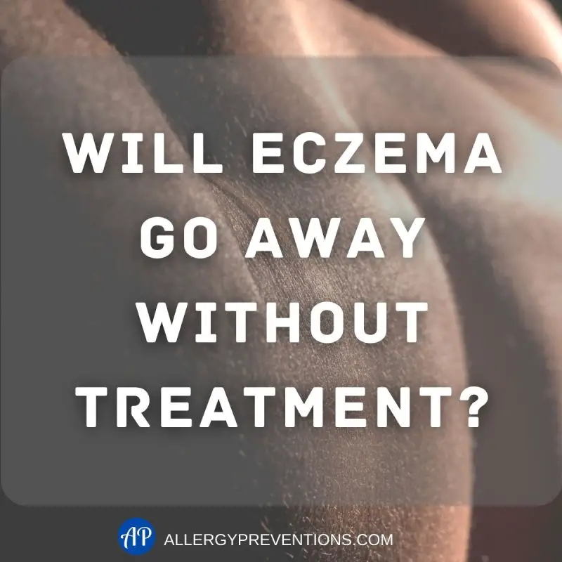 Will Eczema Go Away Without Treatment?
